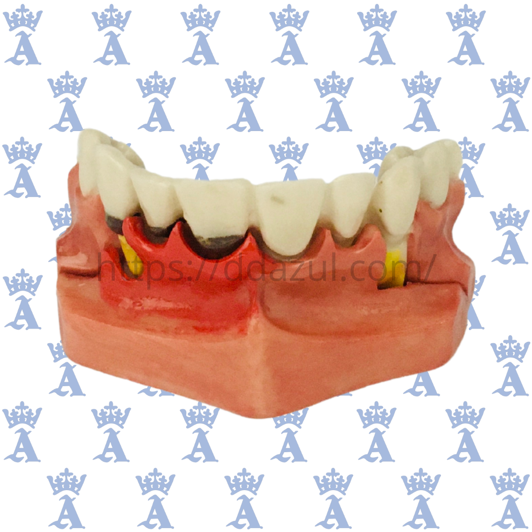 FRONTAL C/PERIODONTITIS SEVERA SANDO 9